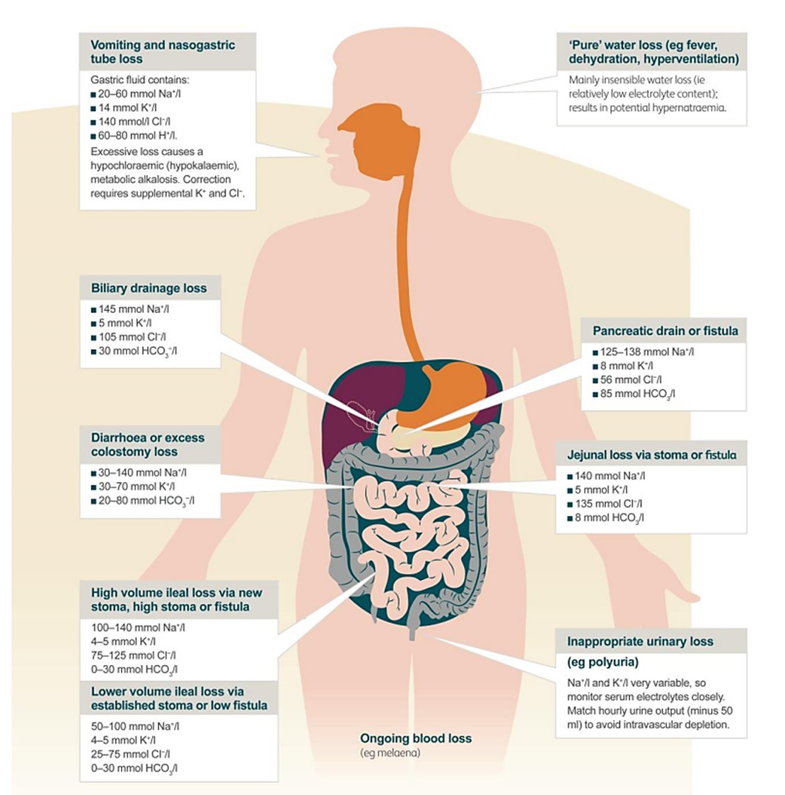 NephroP's tweet photo. Interesting infographic depicting various types of fluid losses and their composition.
Courtesy: 🔗https://t.co/pEEfYmbW1U
#MedEd #Nephrology #MedTwitter https://t.co/KAmnV1MYMX