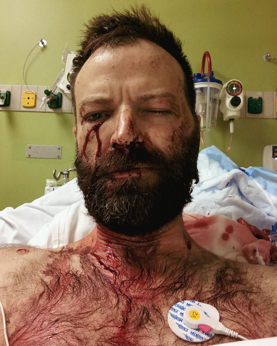 cvock's tweet photo. A year ago I was shot through the head &amp; face in Baltimore. Since then I’ve done everything I could to recover my mind/body/soul as much as possible—a long, wild journey. Experiencing what a single bullet can do, I think it’s important that people actually see it. #EndGunViolence https://t.co/wiP7PWrEyR
