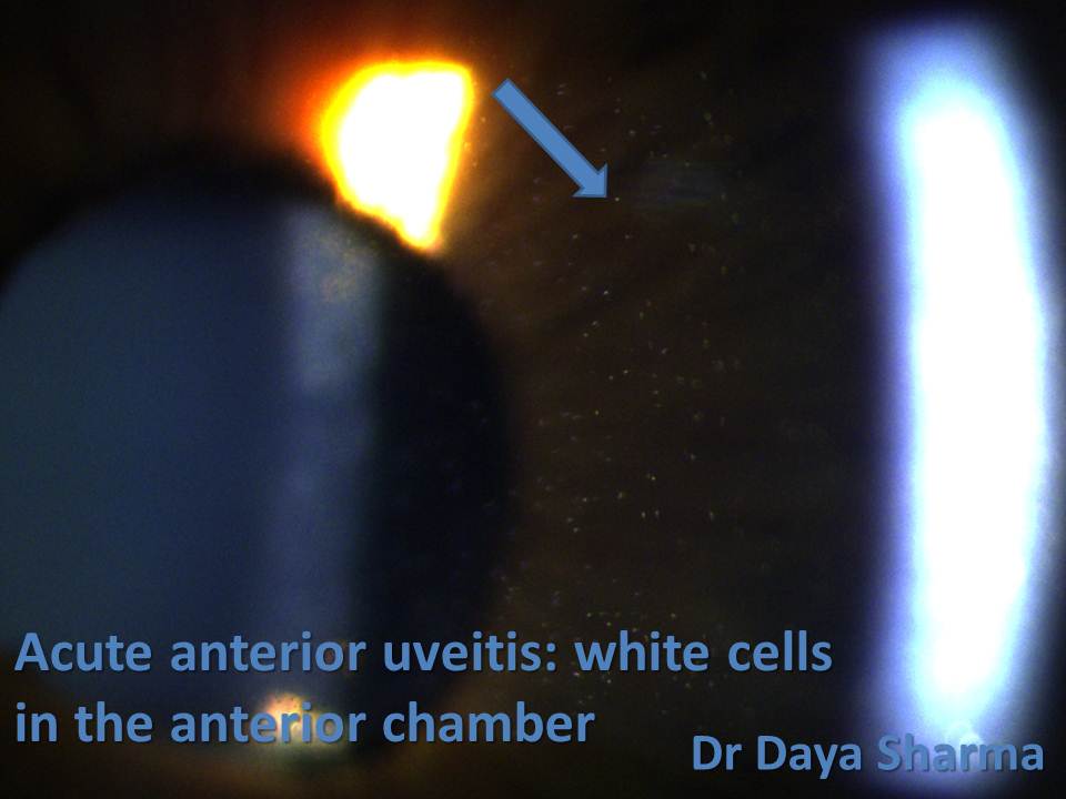 Dr Daya Sharma on Twitter "An important sign in ophthalmology is