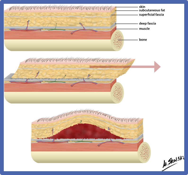 BJSM_BMJ's tweet photo. 🚨 #blog: Morel-Lavallee Lesions 🦴🤔

Do you know the aetiology of this injury❓

What is the optimal diagnosis, investigations and management❓

READ MORE HERE ➡️ https://t.co/tvKEYkV1eA https://t.co/D5fqyz4tc1