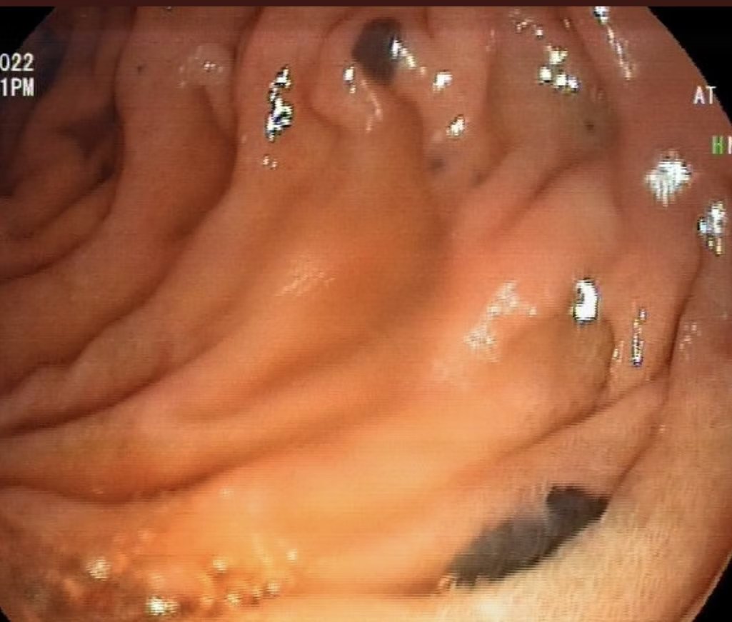 EndoCollab™ | GI Endoscopy Community tweet media
