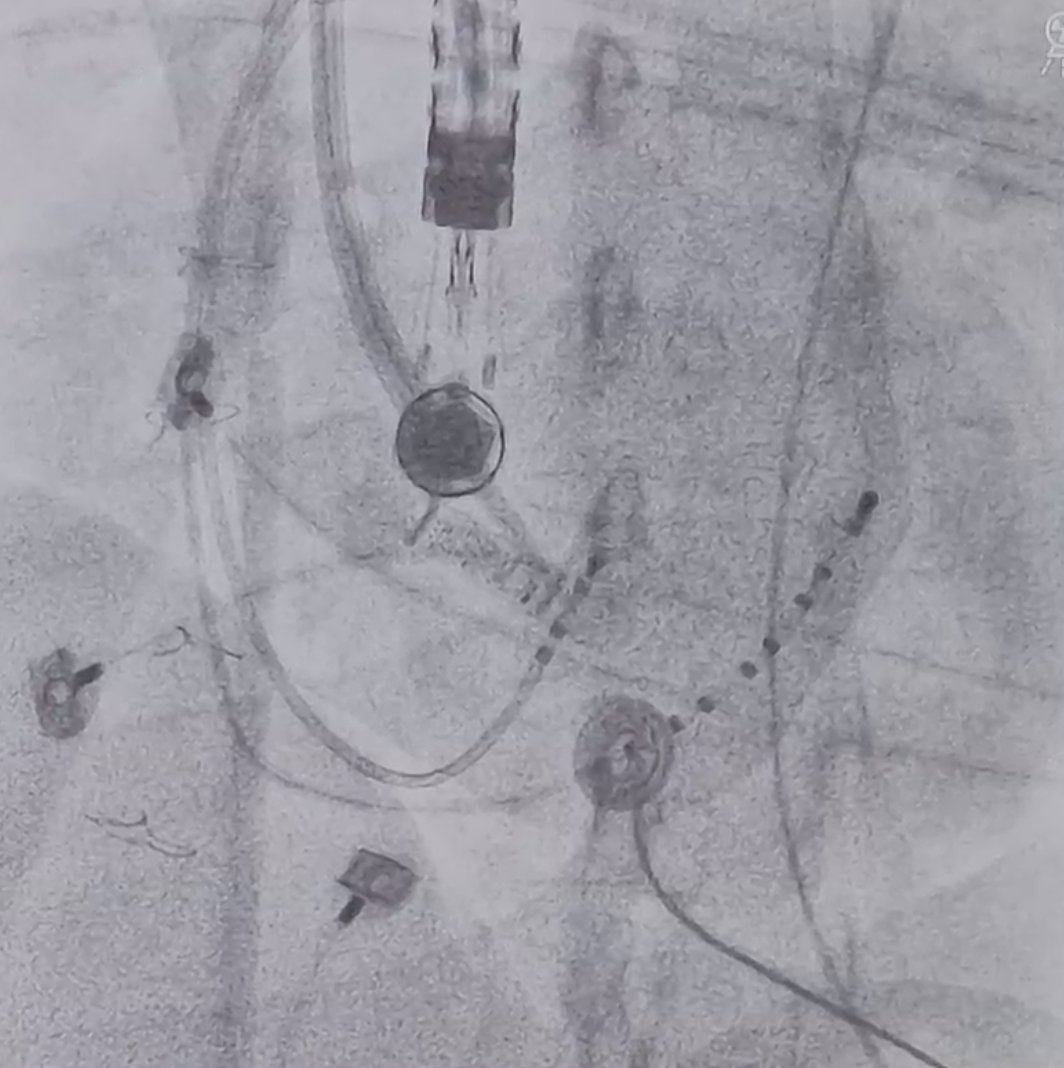 FilippoCauti's tweet photo. Transposition of great arteries REDO postero septal WPW ablation after retrograde access failure. Trans-septal access via right jugular vein with the valuable advice of @Dr_Santangeli #BURNandPUSHtechnique 🇮🇹 https://t.co/AjWZZjjgPE