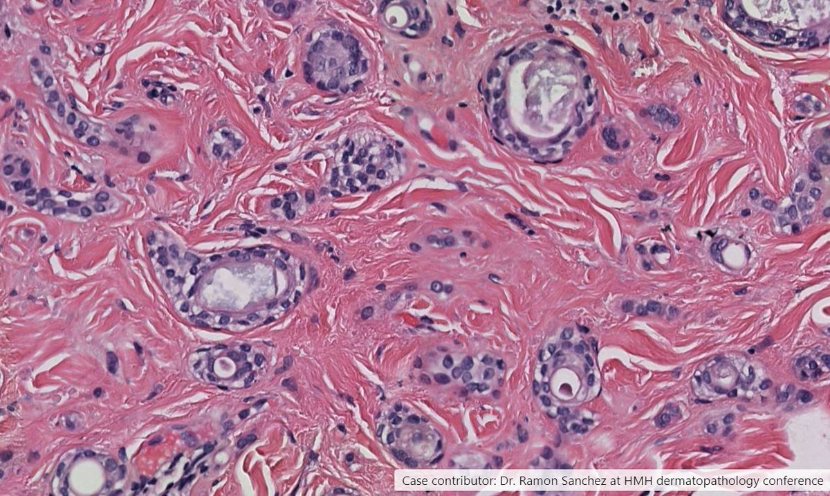 Drmerm's tweet photo. Syringoma
Histologic sections showing cysts, nests and cords in a paisley or tadpole shaped pattern. No cytologic atypia or mitotic figures are seen
#PathTwitter #pathology #dermatology #dermopath #skin #MedTwitter https://t.co/CqxIT77Dkr