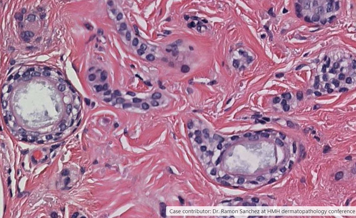 Drmerm's tweet photo. Syringoma
Histologic sections showing cysts, nests and cords in a paisley or tadpole shaped pattern. No cytologic atypia or mitotic figures are seen
#PathTwitter #pathology #dermatology #dermopath #skin #MedTwitter https://t.co/CqxIT77Dkr