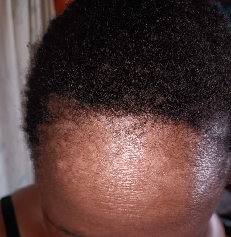 Qokani's tweet photo. Guys we are now glowing and the hair is growing nicely. she is thanking everyone who made it possible for her to reach uMhlongo and I'm thanking to all those who believe in my Godly herbs. 😝💚 https://t.co/Tobfryhib5
