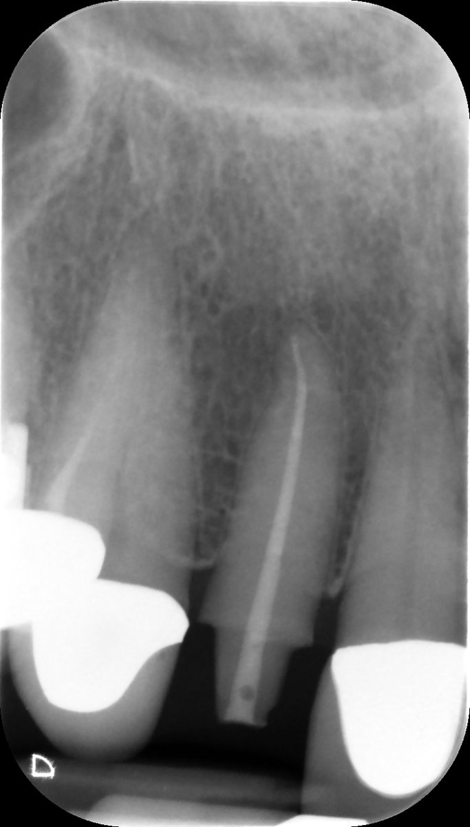 reRCT UR2 and conservative removal of fractured file with ultrasonics. EdgeEndo small prep, Terauchi u/s tip.#savingteeth #endodontics