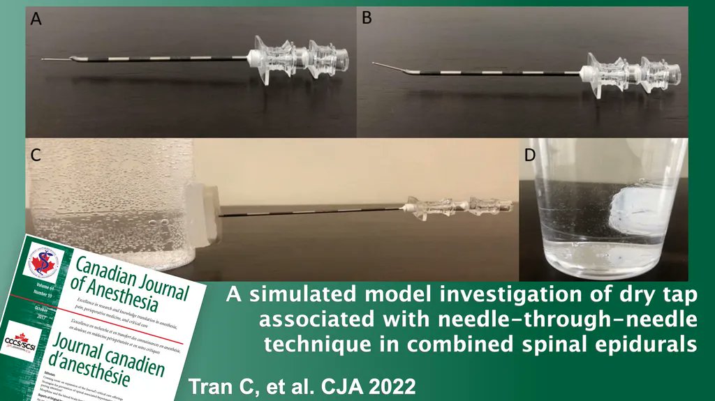 A simulated model investigation of dry tap associated with needle-through-needle technique in combined spinal epidurals | #CJA #Anesthesia #Anesthesiology #OBAnes  buff.ly/3PxZmrw