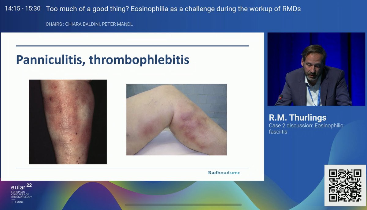 AshimaMakol's tweet photo. ✨Localized #Scleroderma Pearls✨
#EULAR2022
Eosinophilic Fasciitis
👉Contractures wrists/ankles, rarely fingers
👉Mimics- #Lipodermatosclerosis #Panniculitis
👉GCs+MTX 1st line (IV in refractory🧐),MMF 2nd line
✅I add IVIg+/-UVA1 (pending logistics and insurance coverage!) https://t.co/ZErfLxgdxd