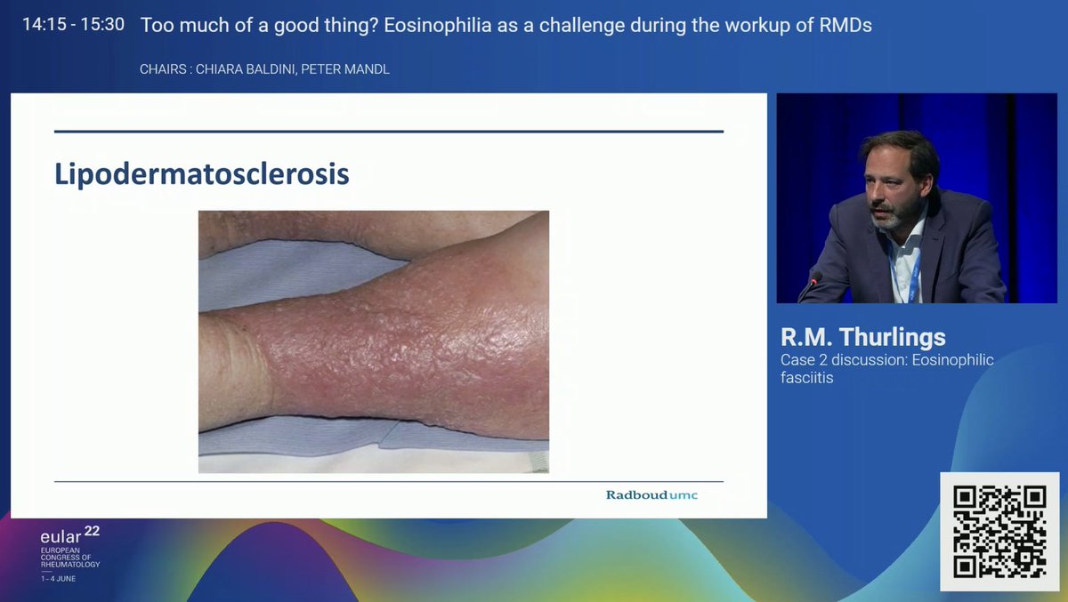 AshimaMakol's tweet photo. ✨Localized #Scleroderma Pearls✨
#EULAR2022
Eosinophilic Fasciitis
👉Contractures wrists/ankles, rarely fingers
👉Mimics- #Lipodermatosclerosis #Panniculitis
👉GCs+MTX 1st line (IV in refractory🧐),MMF 2nd line
✅I add IVIg+/-UVA1 (pending logistics and insurance coverage!) https://t.co/ZErfLxgdxd