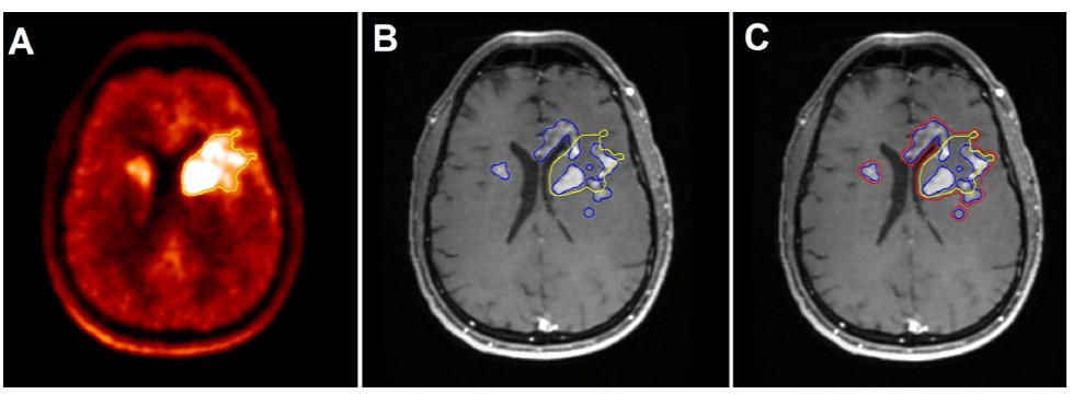 JNeurooncol's tweet photo. 18F-DOPA #PET-guided re-irradiation for progressive high-grade #glioma appears safe and promising for further investigation @wgbreen @n_laack @DavidRoutmanMD @MRuff100 @AnitaMahajanMD @ASTRO_org @MayoCancerCare @MayoRadOnc #radonc 
 https://t.co/Bks0E9a4ej https://t.co/NsS6vEYpaO