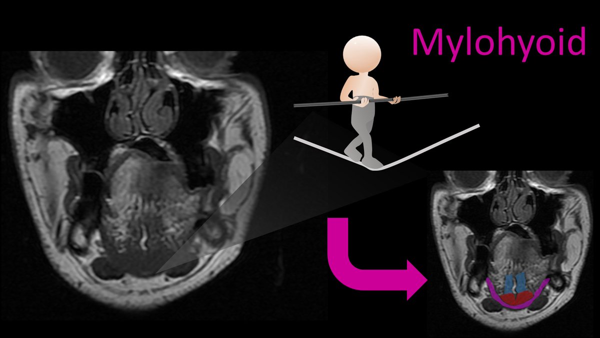 4/The clown shoes look like they are balancing on a tight rope—the tight rope is the mylohyoid. The mylohyoid is easy to remember as the tight rope b/c it is often called the mylohyoid sling—a sling is like a tight rope