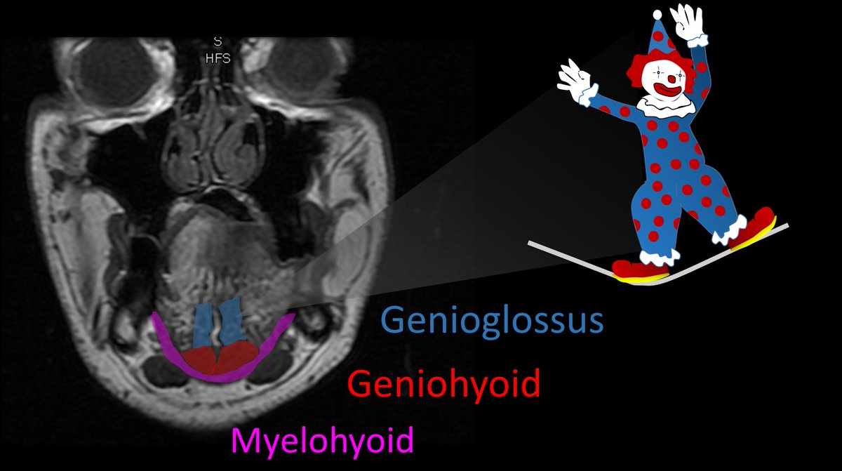 5/ So every time I look at the tongue on imaging, I am looking to make sure I can see my clown walking on a tight rope. Any distortion of that is pathologic.