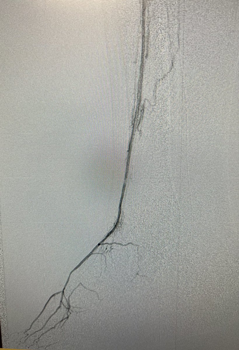 Rest pain, prior pop to distal PT bypass but could not keep flow d/t small plantars. No visible tibial origins. Used bypass to cross pedal loop and retro recan native AT. Love to see the metatarsals at the end!