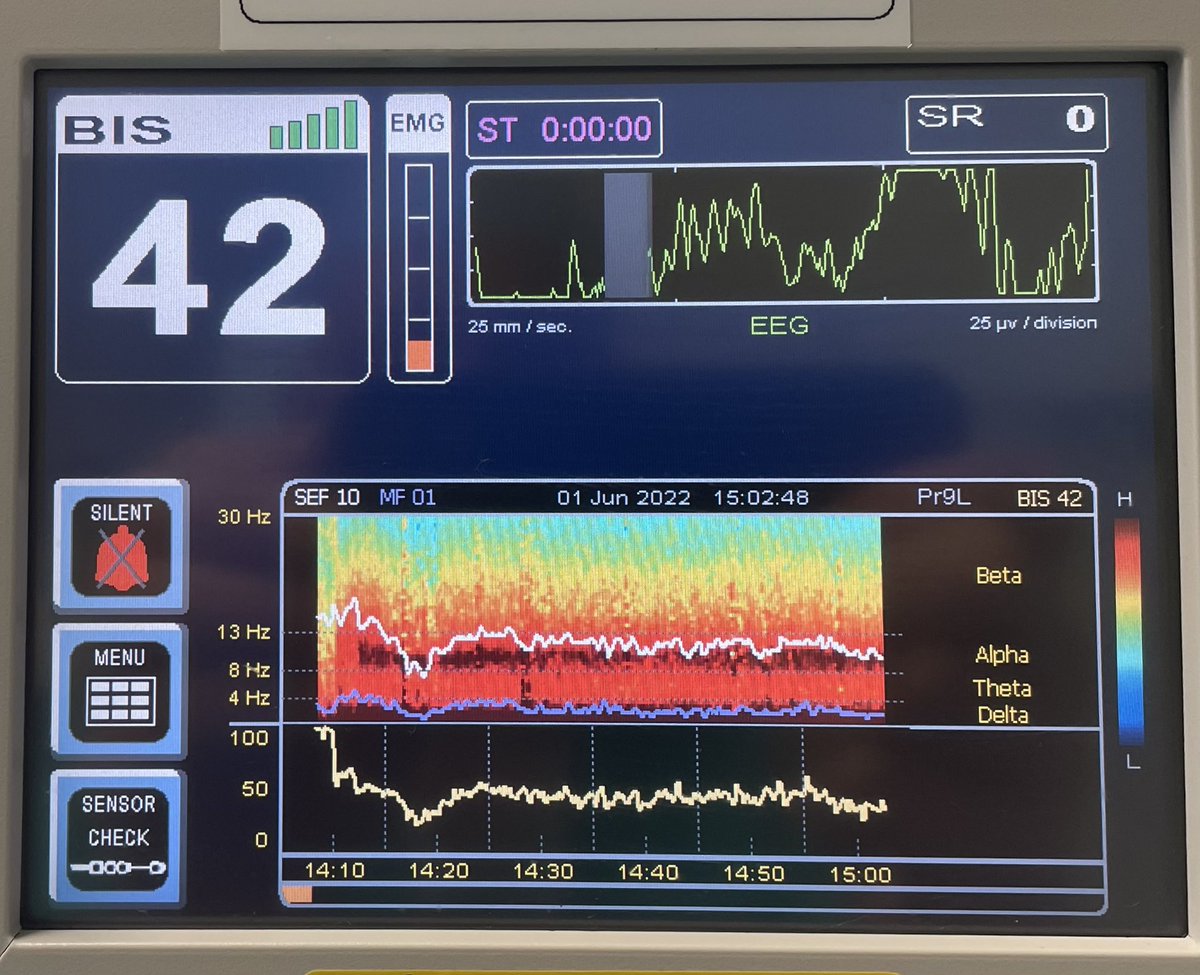 Rollo002's tweet image. A young healthy brain?
TIVA (Prop Schnider/ Remi Minto)
Spectrogram and single channel, unfiltered EEG of a delightful, high-functioning 37yo with Downs Syndrome. #pEEG #BIS #brainmonitoring