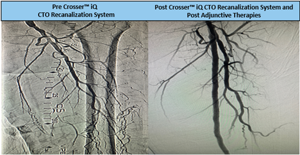 TimHugBD's tweet photo. 20cm CTO in left proximal SFA reoccluding distally into Pop artery. Dr. Cawich used #CrosseriQ catheter & observed a 1 min 23 sec activation time to cross! #CrossThisFast
For use in peripheral artery CTOs; Not for use in carotid arteries. Safety info: https://t.co/yWXvp2is8W https://t.co/TIUg7RVgAI