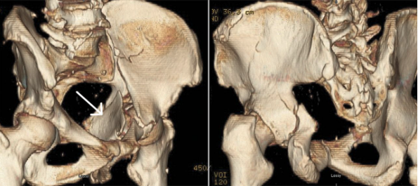 jbjs's tweet photo. Updated #JBJSClinicalSummary on Acetabular Fractures in the Elderly #Hip #Trauma
By: Kelly Lefaivre, MD
https://t.co/BPar1nvINu https://t.co/oHyhtgwBfp