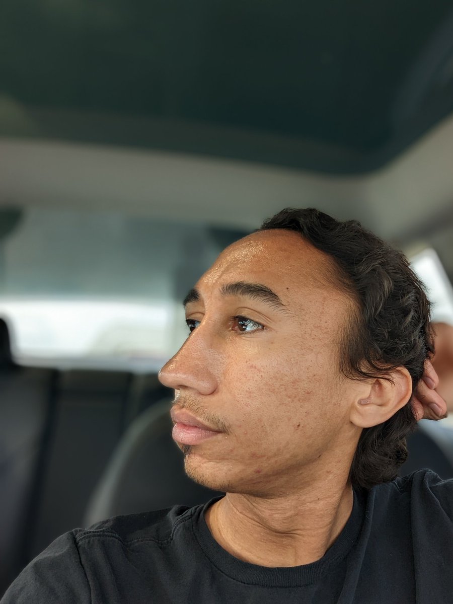 Dev__devv's tweet photo. 14/14 And for people curious, this is how my face currently looks https://t.co/QnTtxrcCRD