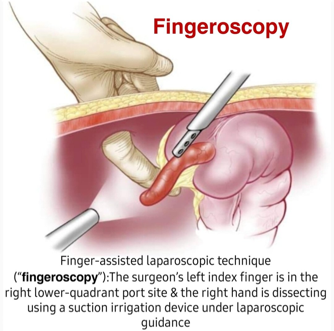 DRAFTABAHMED7's tweet photo. 𝗙𝗶𝗻𝗴𝗲𝗿𝗼𝘀𝗰𝗼𝗽𝗶𝗰 treatment of complicated appendicitis: (Less practised in Modern Era)
𝗥𝗲𝗳:
https://t.co/B7Gj4SdCjq https://t.co/7tqQRY06hf