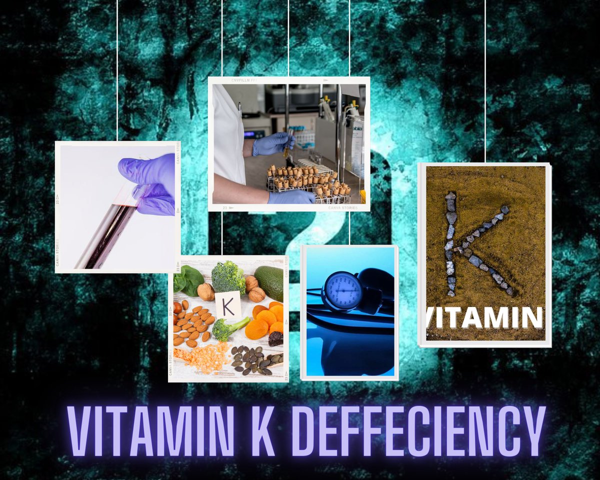 Vitamin K deficiency commonly occurs during the neonatal period, with hereditary combined vitamin K-dependent coagulation factor deficiency (VKCFD), inadequate food intak... Read full article on our website-mediworldd.xyz/2022/05/Vitami…
#mediworld #healthy #meded #MedTwitter  #follous