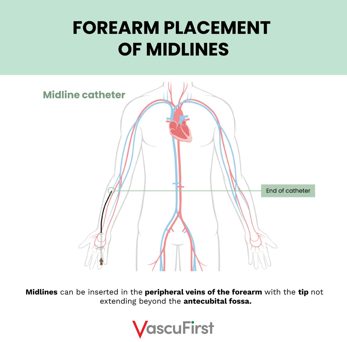 VascuFirst's tweet image. ⬇️The differences in placement between PICCs, midlines (forearm placement), TCVCs &amp;amp; TIVADs.
From our article "Peripherally inserted central catheters: the key principles", written by Dr @LindajKelly277 
Here is the link to the full piece: vascufirst.com/piccs/peripher…