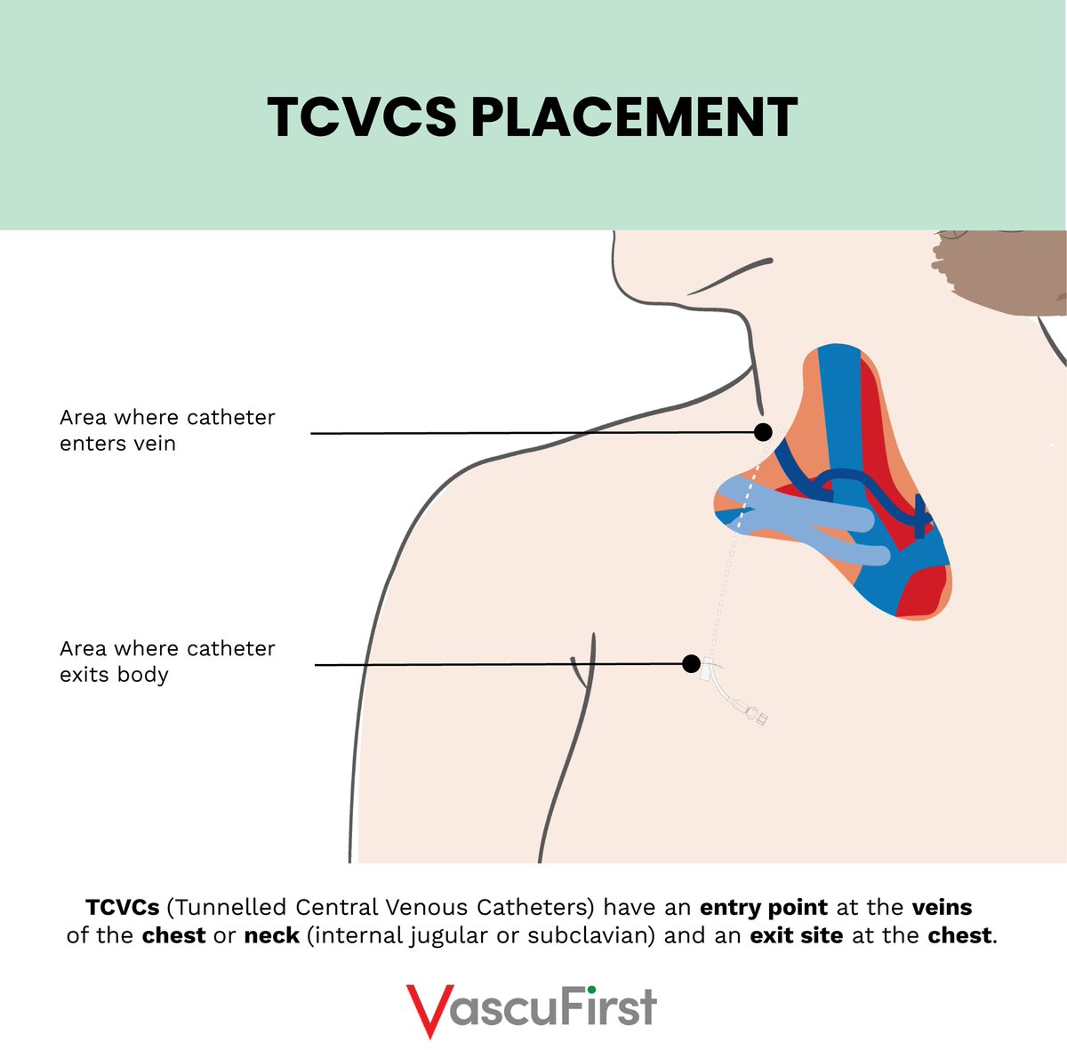 VascuFirst's tweet image. ⬇️The differences in placement between PICCs, midlines (forearm placement), TCVCs &amp;amp; TIVADs.
From our article "Peripherally inserted central catheters: the key principles", written by Dr @LindajKelly277 
Here is the link to the full piece: vascufirst.com/piccs/peripher…