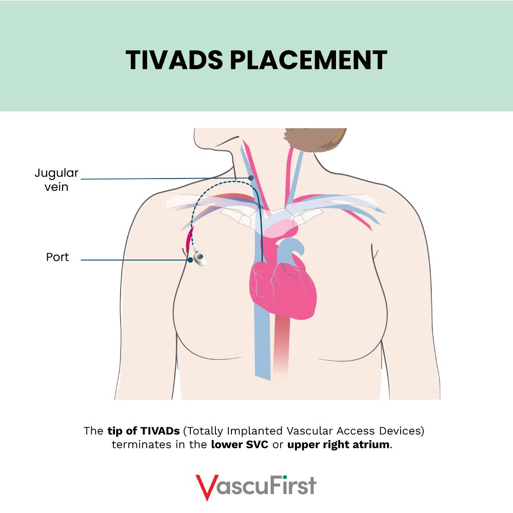 VascuFirst's tweet image. ⬇️The differences in placement between PICCs, midlines (forearm placement), TCVCs &amp;amp; TIVADs.
From our article "Peripherally inserted central catheters: the key principles", written by Dr @LindajKelly277 
Here is the link to the full piece: vascufirst.com/piccs/peripher…