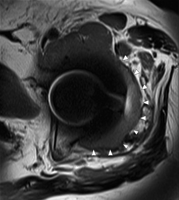 jbjs's tweet photo. Updated #JBJSClinicalSummary on Total #Hip #Arthroplasty Bearing-Surface Biomaterials #THA
By: Tad M. Mabry, MD
https://t.co/8VKnhKQnWf https://t.co/UkIA0pjgkb