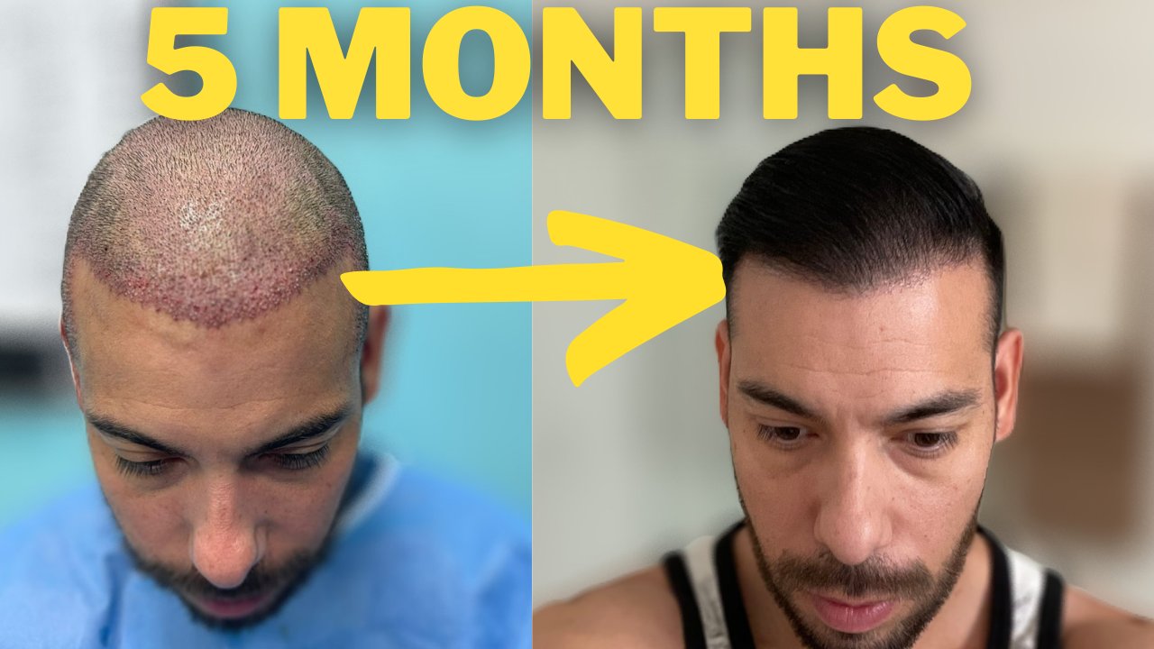 Bens 4 month hair transplant results with before and after photos