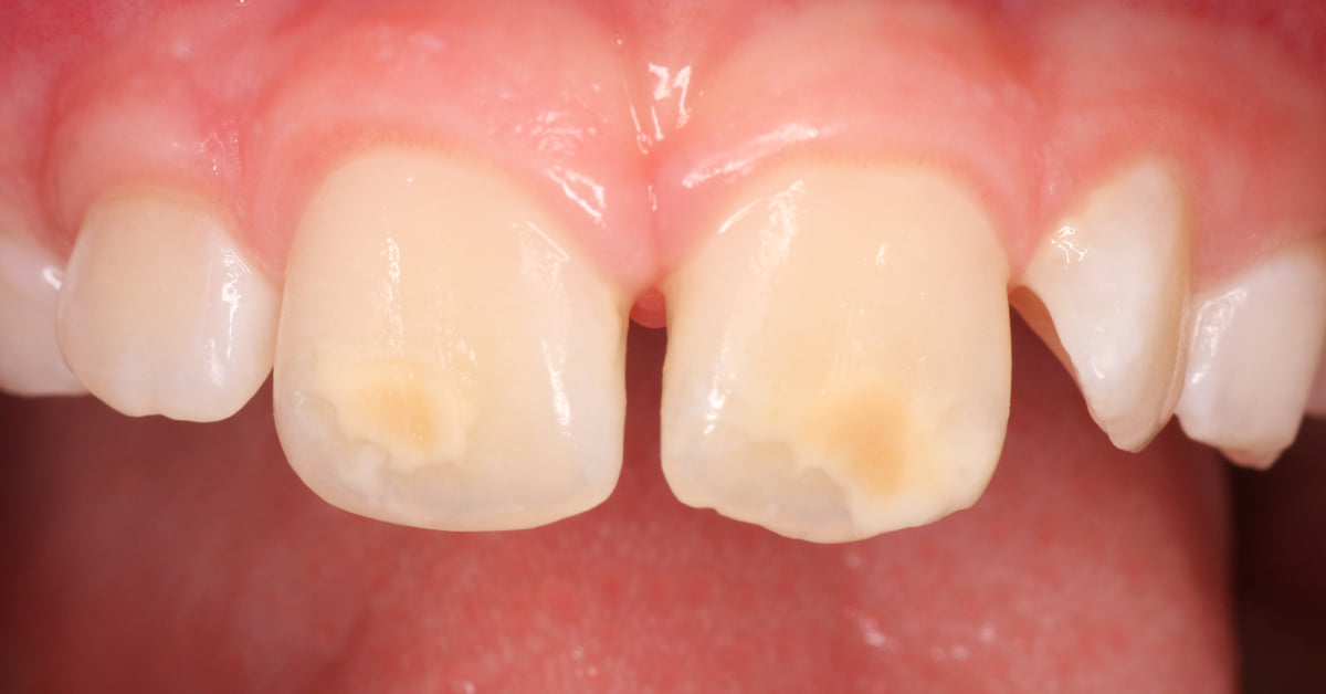 Infantident tweet picture