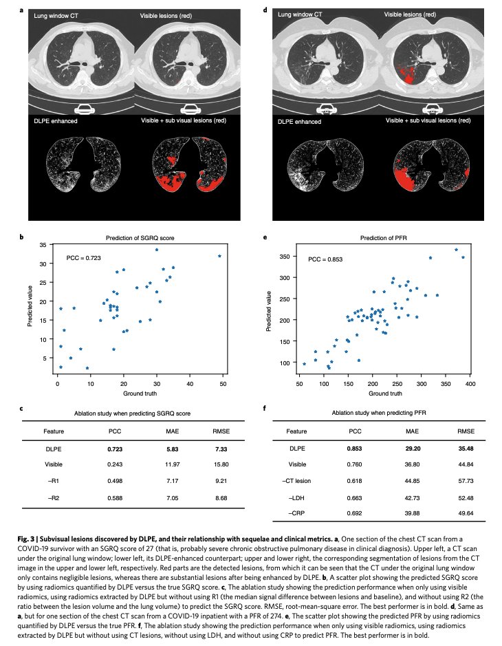 BioDecoded's tweet photo. An interpretable deep learning workflow for discovering subvisual abnormalities in CT scans of COVID-19 inpatients and survivors | Nature Machine Intelligence
https://t.co/AoEixohndD

#DeepLearning https://t.co/sGALyQGo5u