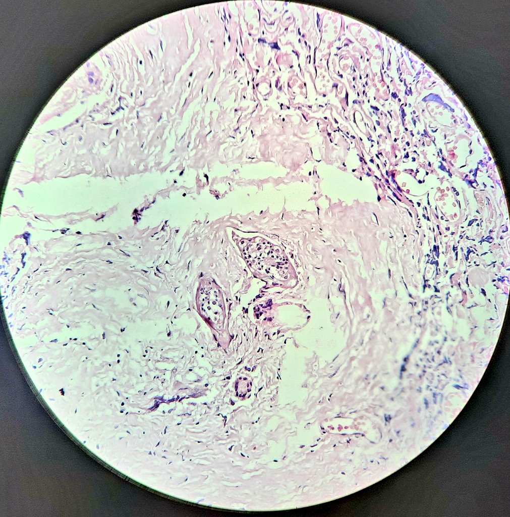 cherradi07's tweet photo. 15 years old boy. Cauda equina syndrome.Medulla biopsy. https://t.co/Y6feLfrS5K