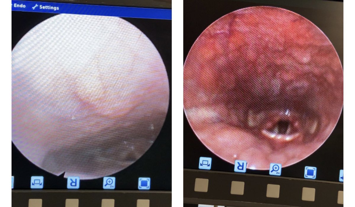 ewenn16's tweet image. Left: healthy throat
Right: 1-week post recovery from #covid19 throat
😯 just imagine the covid throat during the active symptomatic phase