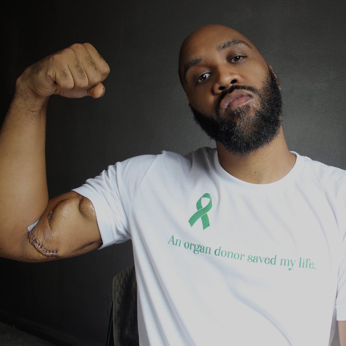 TreValeDion's tweet photo. There’d be no more July 9th’s for me to celebrate had there not been a June 1, 2017. 5 years #KidneyStrong 🎗💚💪🏾
#KidneyDisease #Kidneyversary #ESRD #KidneyTransplant https://t.co/7F6gZlmVFL