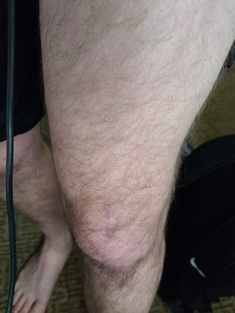 RecoveryofG's tweet photo. Here's the current two leg comparison. Muscular healthy leg compared to the repaired leg lacking a lot of quad muscle https://t.co/coSkONOzmu