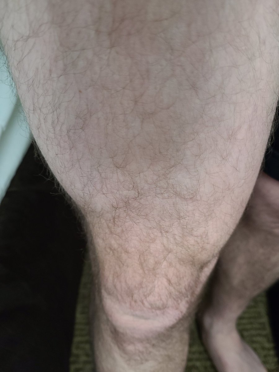 RecoveryofG's tweet photo. Here's the current two leg comparison. Muscular healthy leg compared to the repaired leg lacking a lot of quad muscle https://t.co/coSkONOzmu