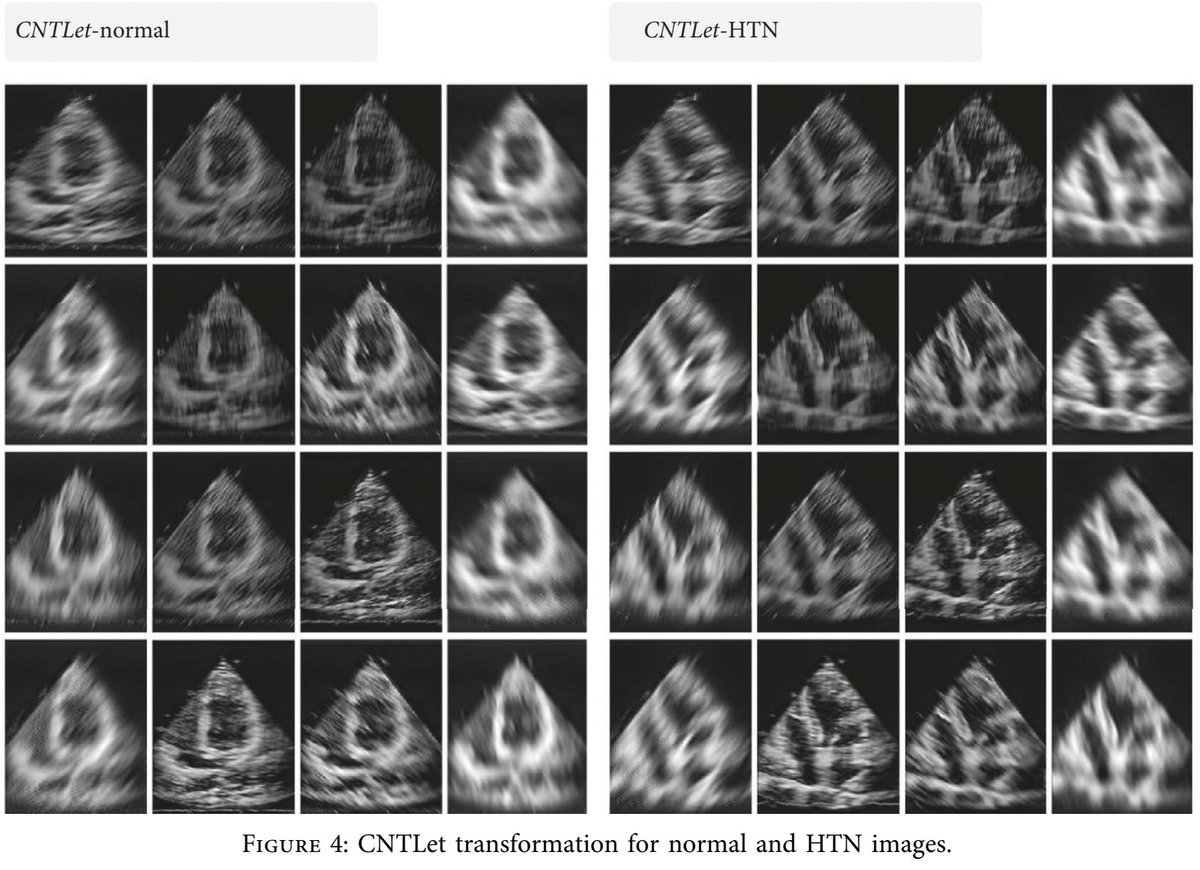 Alimedphysics's tweet photo. The proposed #multi_resolution #CAD system can be utilized for the detection of early #hypertension-induced left ventricular heart muscle changes using #ultrasound imaging. See more on Contrast Media &amp; Molecular Imaging: https://t.co/rXt9nVqmDr
@HindawiMedicine
@HindawiMECS https://t.co/GuPAiAoWYH