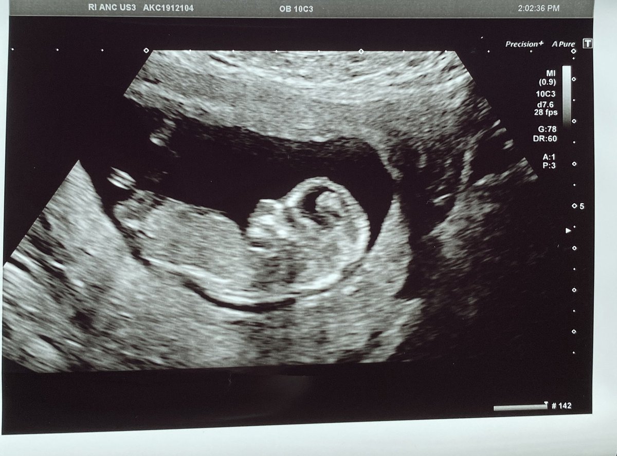 makingbabyb's tweet photo. After 2.5 years, we officially made it to 12 weeks 🥺❤️👶🏼 All starting to sink in now.  We are actually pregnant 🥰 #icsi #ivf #ttc #12weeks4days https://t.co/ogKiuGN1xk