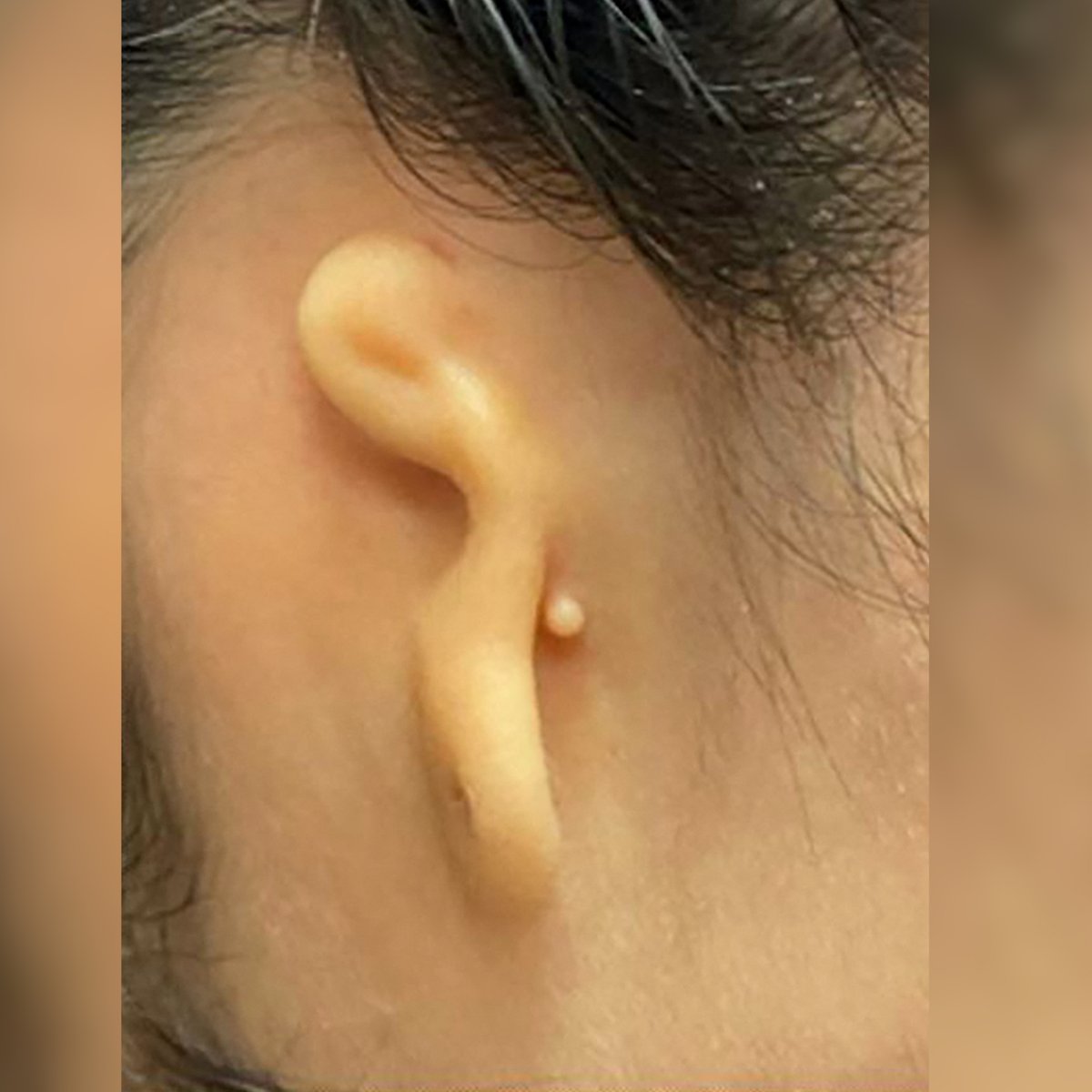 cgtnamerica's tweet photo. A U.S.-based biotech company says it used a woman’s own cells to 3D print an ear implant which was successfully transplanted into the 20-year-old patient, a world’s first application for this technology.
#3DPrintedEar #3DPrintingBodyParts https://t.co/8ByKs8Is2W
