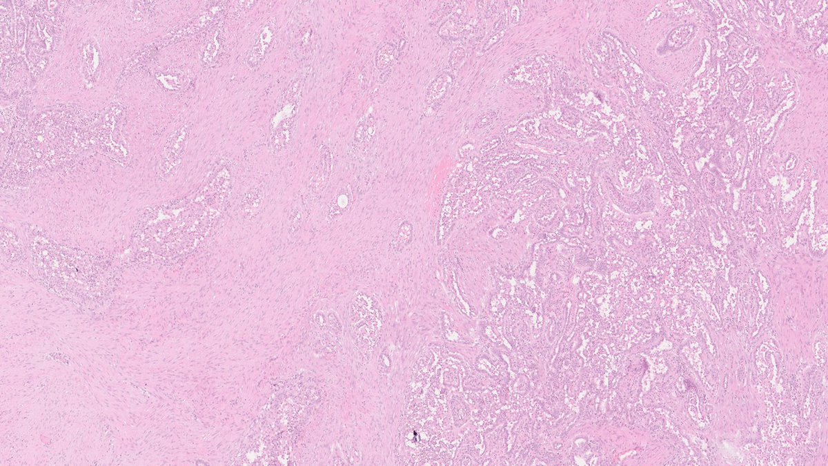 40 mm thyroid tumor, preop. Bethesda VI. Routine histology reveals a biphasic tumor; epithelial component with fjord-like arrangements in quite a cellular stroma.
