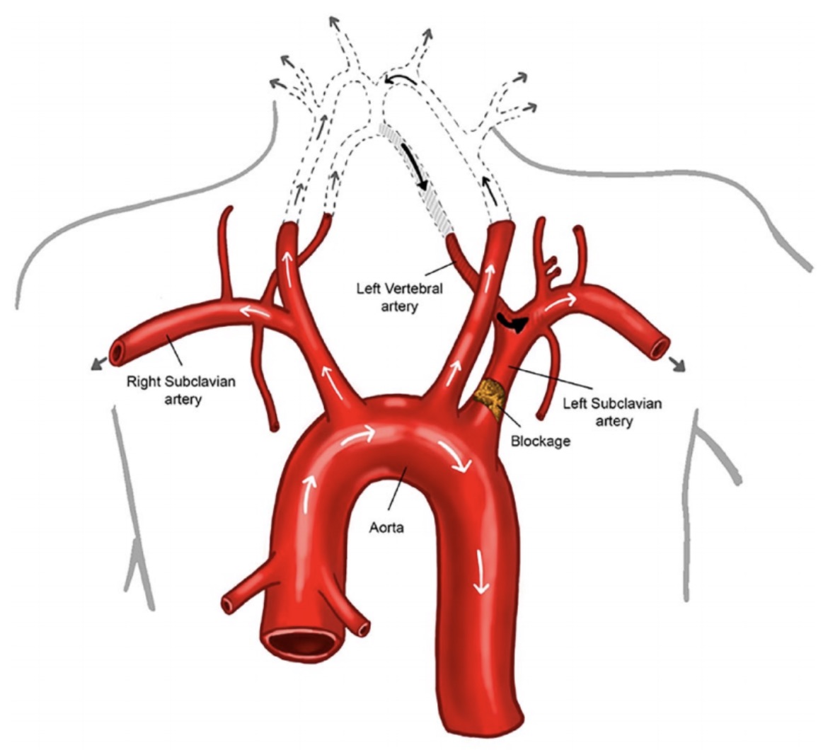 Subclavian artery stenosis. What do you need to know? Access our Vascular Medicine Patient Information Page, written by experts @shireen_khoury & @evratchford ow.ly/KQOk50FuBit #vascular #meded