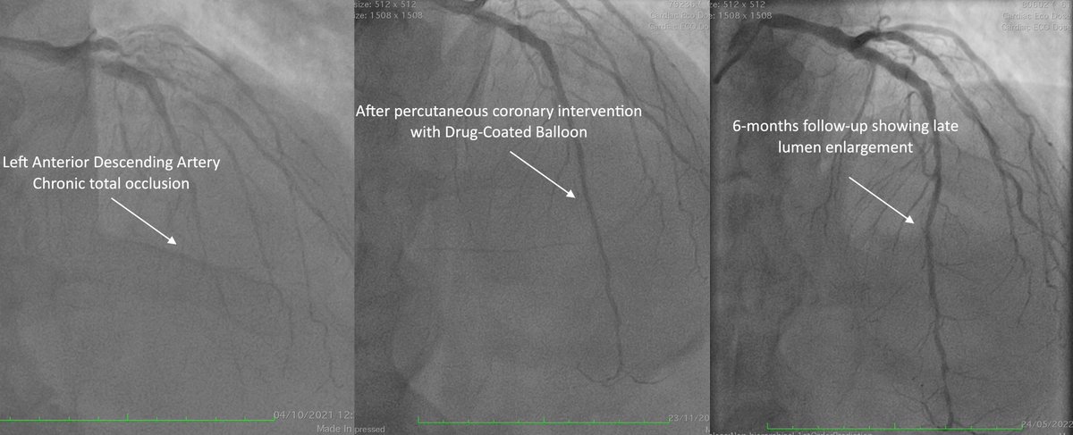 picard_fabien's tweet photo. CTO PCI of LAD mid&distal segments treated with DCB. Anterograde approach with Recross microcatheter & Judo 6. PCI with 2.0 & 2.5mm @bbraun_com SequentPleaseNeo DCB @HopitalCochin
Would you use DCB for true to true CTO cases? @PCRonline @CongresActif #PCICase https://t.co/5vOApDivvA