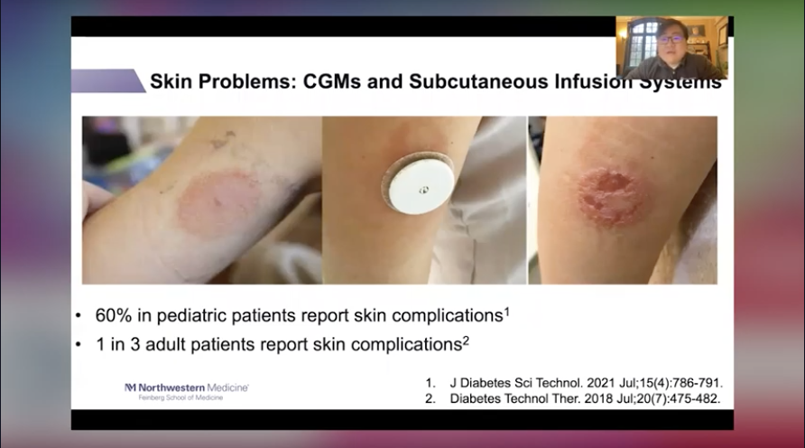 DData_Diabetes's tweet photo. Dr. Xu: The ugly of wearable tech in diabetes (and beyond). The not-fun skin probs that can materialize, especially for CGM users. #DData2022 #DData -MH https://t.co/0l2Jgise7b