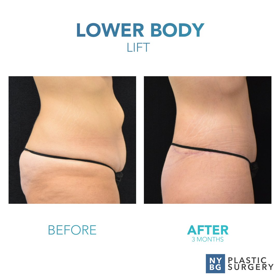 DrKevinSmall's tweet photo. Plastic Surgery gave Caitlyn her life back! Feel confident again in your own skin with a lower body lift at NYBG Plastic Surgery.
To see more amazing transformations, visit: https://t.co/vaMVnNcgSY
#NYBGPlasticSurgery #LowerBodyLift #SkinRemoval #Inspiration #Motivation https://t.co/vRVICXHn2b