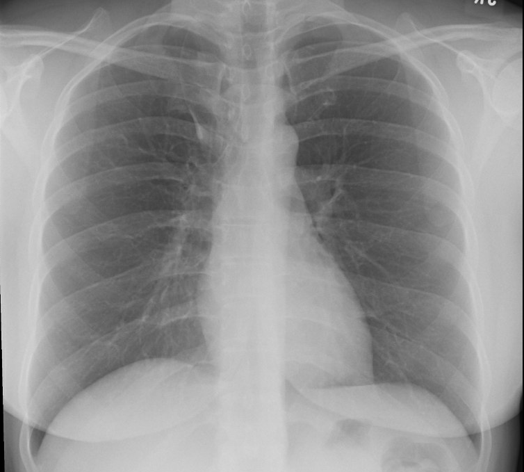 crit_caring_MD's tweet photo. Interesting benign finding on an outpatient CXR.  Can you spot it? 👀👀👀

@VCU_PCCM 
@VCU_IMRes 
#CHESTTrainee https://t.co/Qk9gX27Ujb