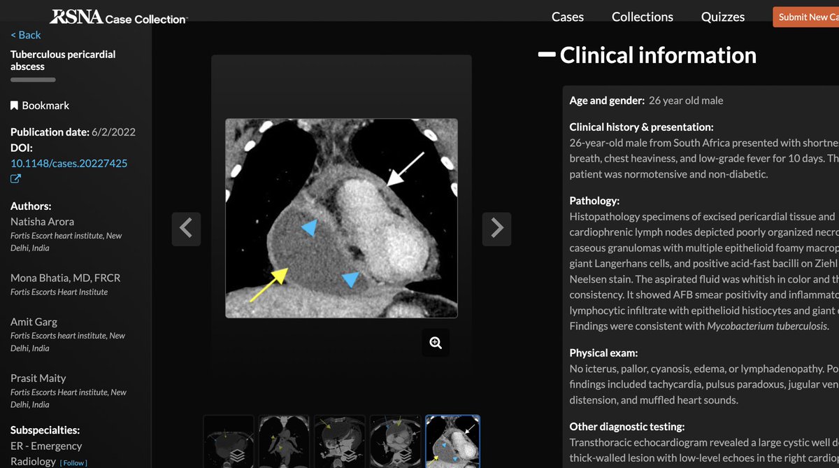 Natisha555's tweet photo. Yet another case published in RSNA case collection ! 😇
A very interesting case of pericardial abscess in a young man from South Africa, secondary to tuberculous Constrictive Pericarditis

#rsna #radiology #cardiacradiology https://t.co/IswFvWIX5b
