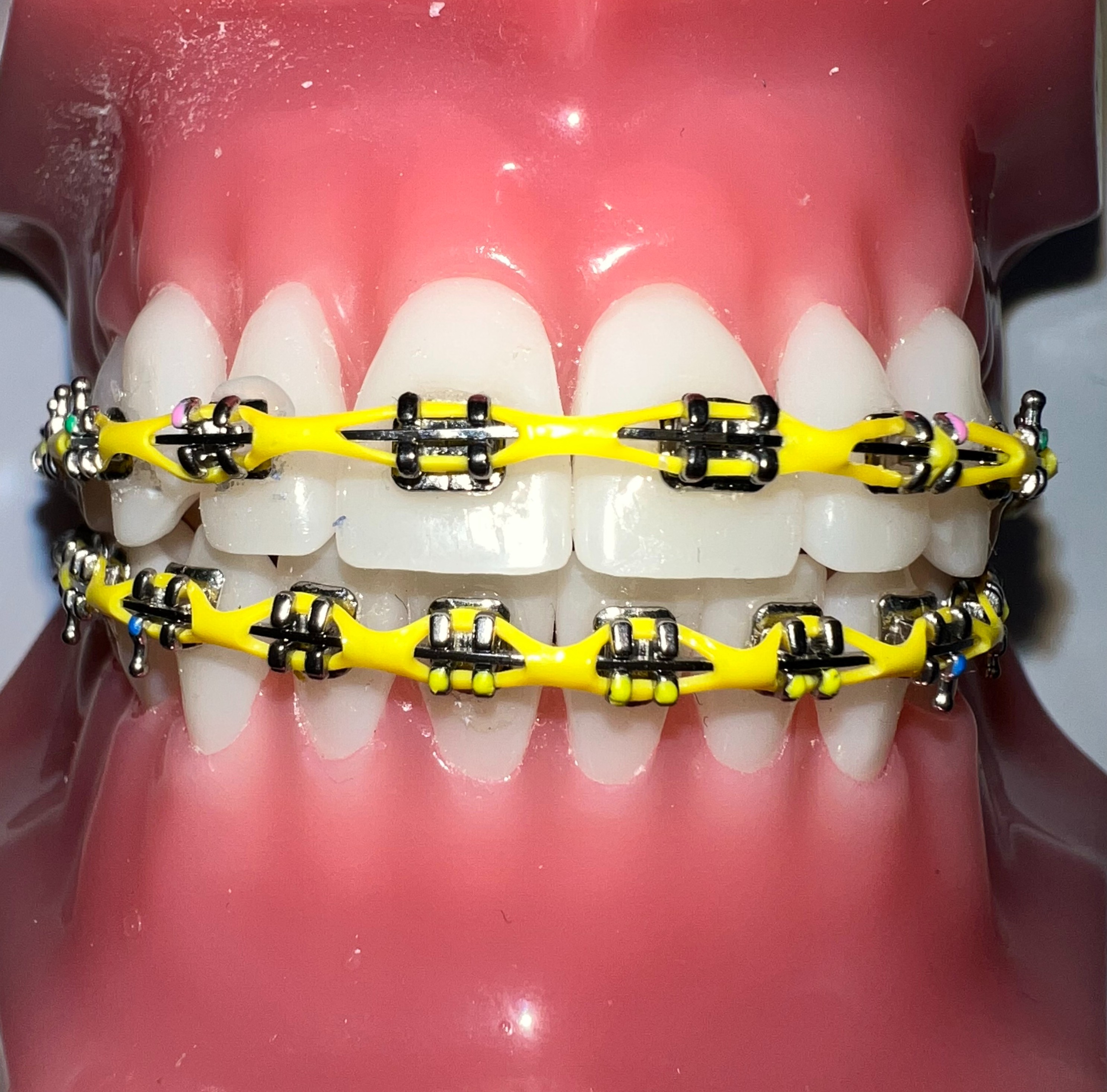 Risas Dental Braces on X