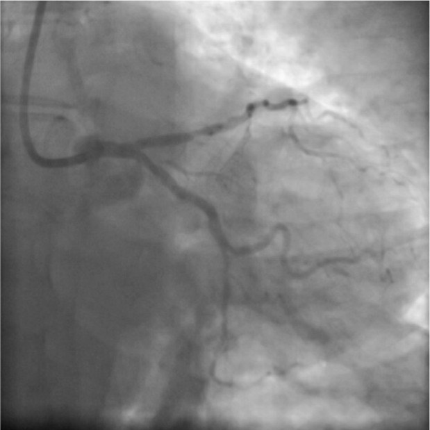 ASNC Society (@myasnc) on Twitter photo A 58-year-old woman with hypertension, underwent #SPECT and angiography for evaluation of recurrent chest pain and dyspnea on exertion despite medical management.
Join <a href="/CesiaGallegos/">Cesia Gallegos, MD MHS FASNC</a> at #CVNucinWomen where she will tackle this case!
👉bit.ly/3q4xu36
#CVNuc A 58-year-old woman with hypertension, underwent #SPECT and angiography for evaluation of recurrent chest pain and dyspnea on exertion despite medical management.
Join <a href="/CesiaGallegos/">Cesia Gallegos, MD MHS FASNC</a> at #CVNucinWomen where she will tackle this case!
👉bit.ly/3q4xu36
#CVNuc