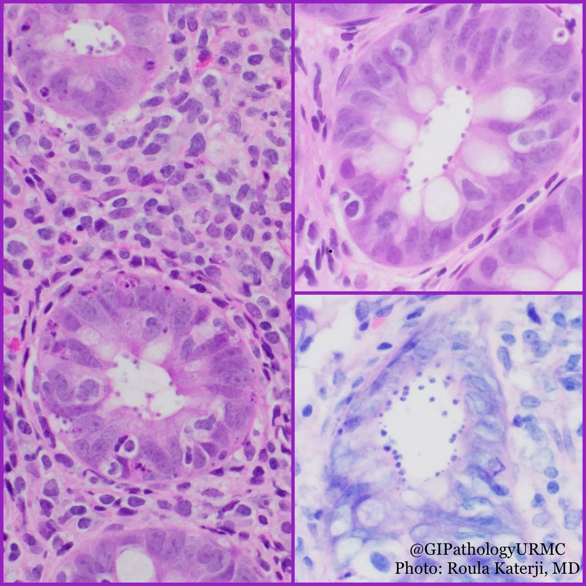 Do you see the basophilic spheres on the microvillous border of the colon? 
Cryptosporidia: the pic shows the organisms bulging out from the epithelial cells toward the lumen. Giemsa and gram stains can highlight the organisms. It is spread by fecal-oral route #GIpath #pathology
