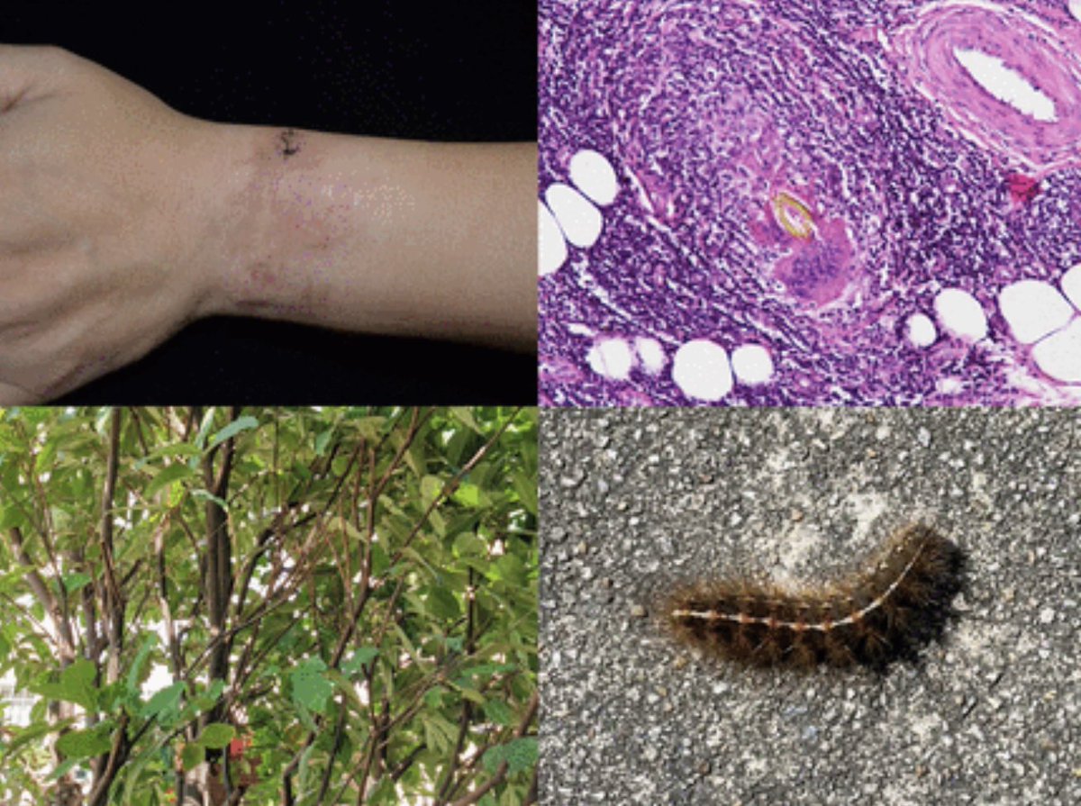 docramiro's tweet photo. Paciente de 50 años con enrojecimiento y dolor en muñeca izquierda por 5 meses sin respuesta a medicamentos posterior a trepar un árbol y ser "mordido" por un insecto. Al tomar biopsia se encontró una reacción de cuerpo extraño por pelos de oruga. 
😟 🐛
https://t.co/t1ktBsmZbY https://t.co/kSWnykfIEQ
