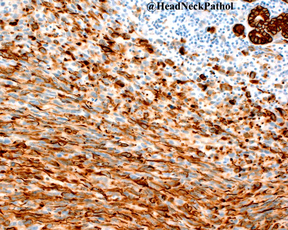 Epithelioid and Spindle Cell Rhabdomyosarcoma of the Oral Mucosa with FUS Rearrangement
By Adam R. Ochsner &amp; Robert D. Foss
rdcu.be/cORvK
#HeadNeckPathol #HNPJ #HeadandNeckPath #Pathology #ENTPath #PathologyTweet